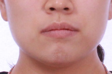 부산비발치교정