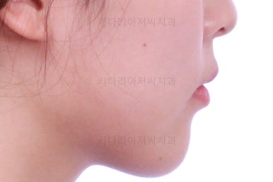 부산클리피씨교정