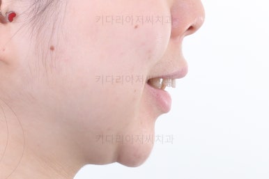 부산연산동교정치과