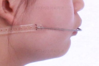 부산어린이치아교정