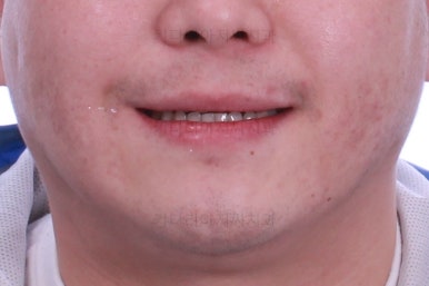 연산동임플란트