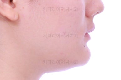 연산동치아교정