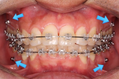 부산교정치과추천