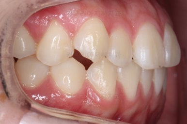 부산치아교정잘하는곳