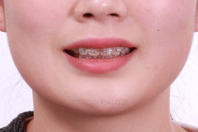 부산앞니부분교정