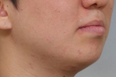 부산구순구개열