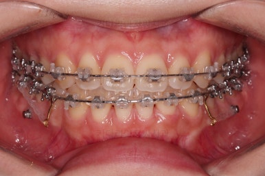 부산치아교정추천