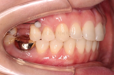 부산치아교정비용