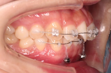 부산앞니부분교정