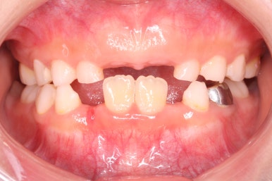 부산어린이치아교정