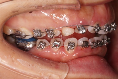 부산구순구개열