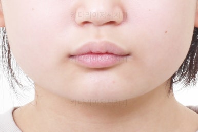 부산어린이치아교정