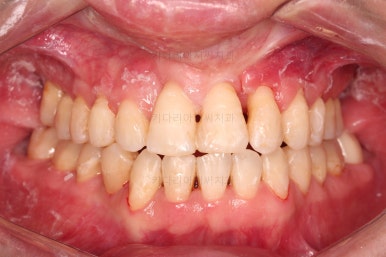 부산구순구개열교정