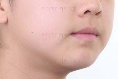 부산토끼치아교정