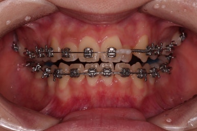 동래구치아교정