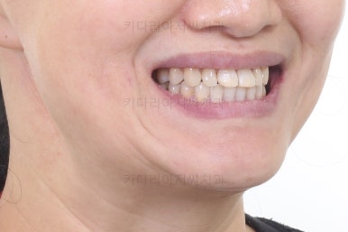 부산치아교정잘하는곳