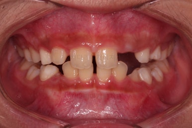 부산어린이돌출입교정