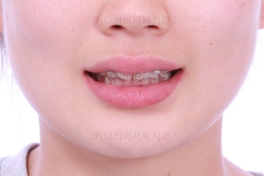 부산앞니부분교정