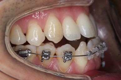 부산비수술교정