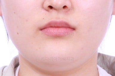 부산치아교정