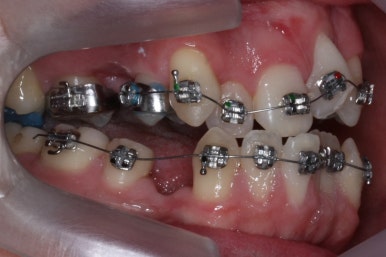 부산구순구개열