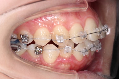 부산클리피씨교정