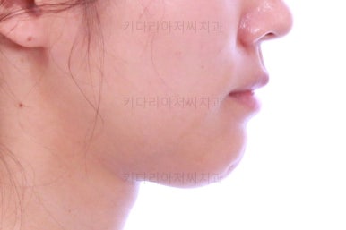 부산치아교정잘하는곳