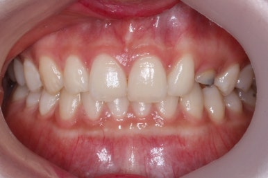 부산매복치아교정