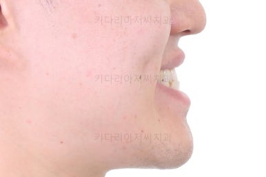 부산비수술교정