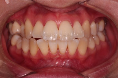 부산치아교정잘하는치과