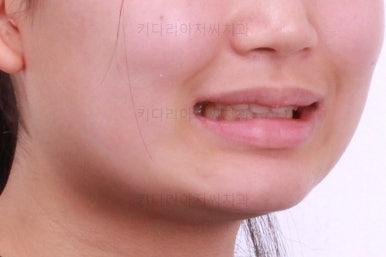 부산어린이치아교정