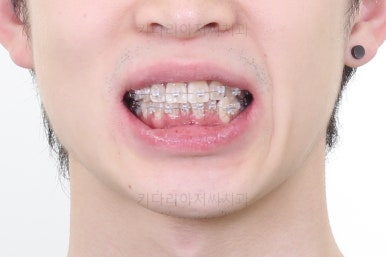 부산돌출입교정