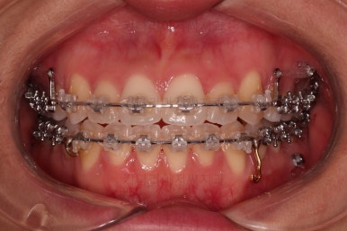 부산비발치교정