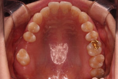 부산치아교정비용