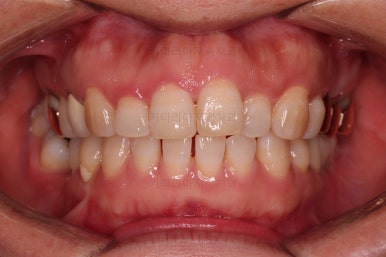 연산동부분교정