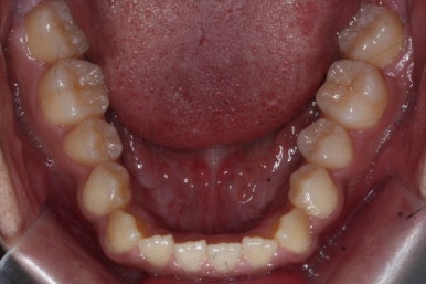 부산주걱턱교정