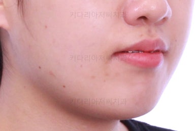 부산비발치교정