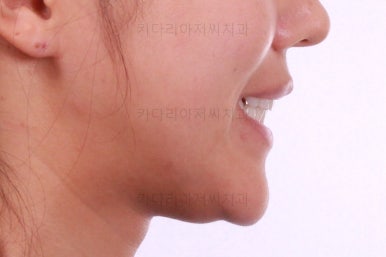 부산치아교정잘하는곳