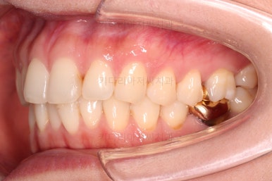 부산치아교정비용