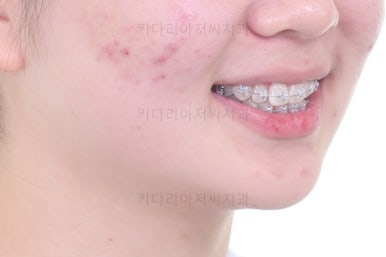 부산치아교정잘하는곳