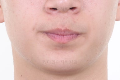 부산청소년치아교정