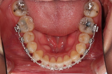 부산치아교정잘하는곳