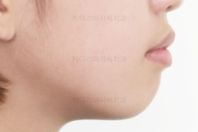 부산치아교정전문의
