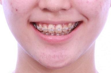 부산비발치교정