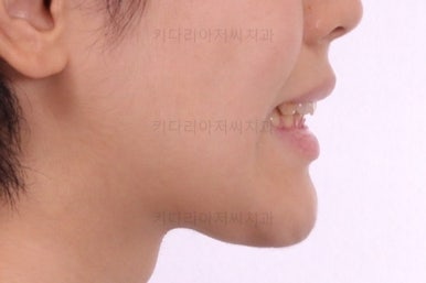 부산연산동치아교정
