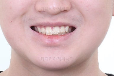 부산연산동사랑니발치