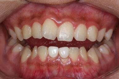 연산동치아교정