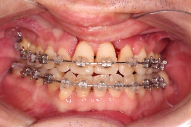 부산구순구개열교정