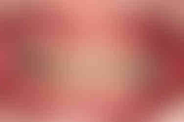 부산구순구개열교정