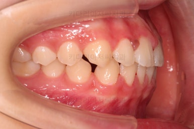 부산앞니벌어짐교정